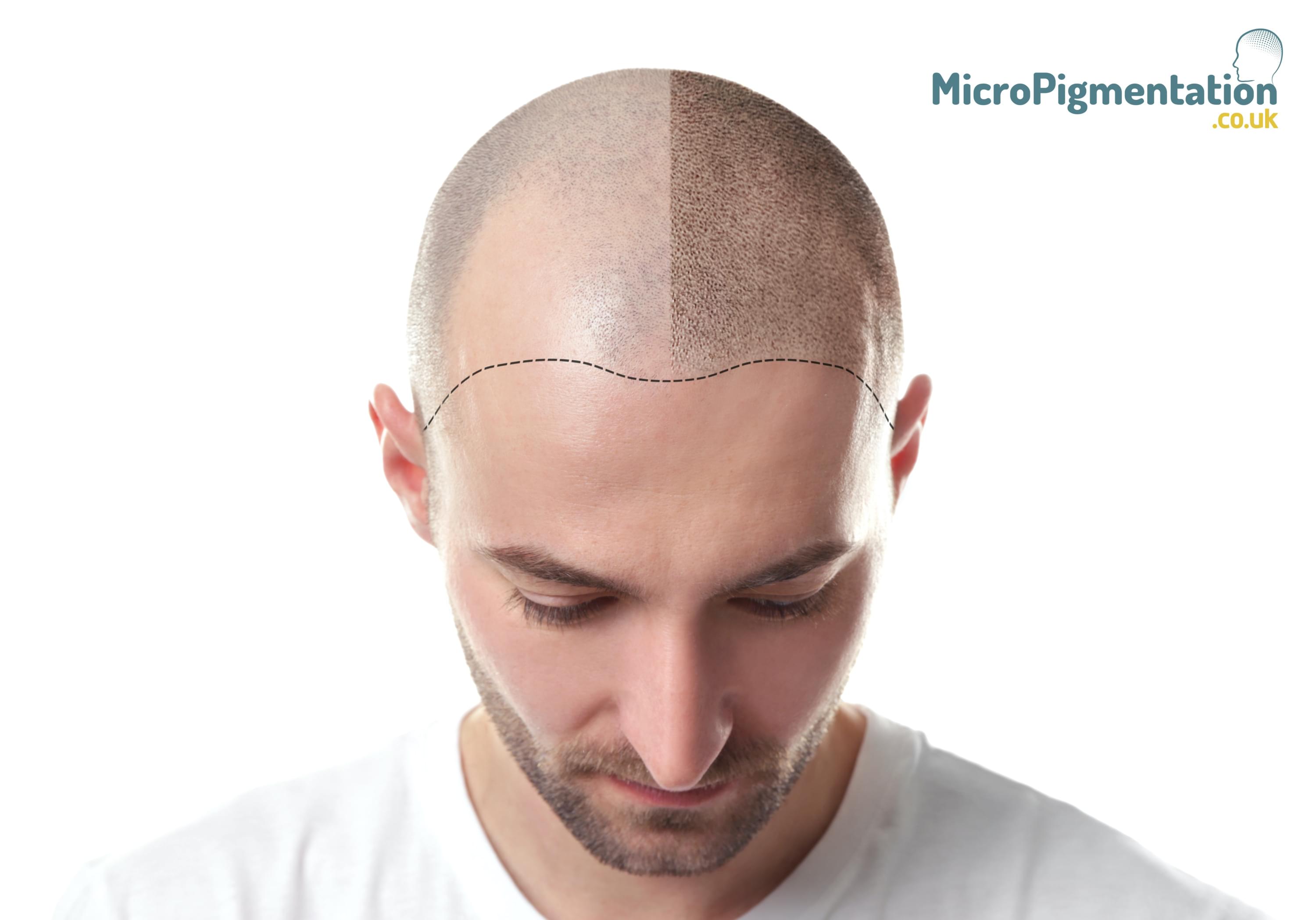 scalp micropigmentation